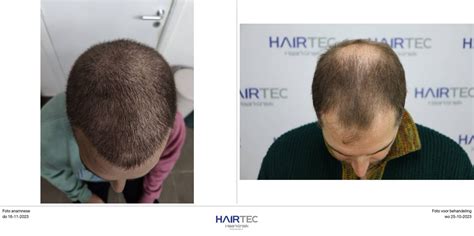 Haartransplantatie Deflt: Waar Moet Je Op Letten?