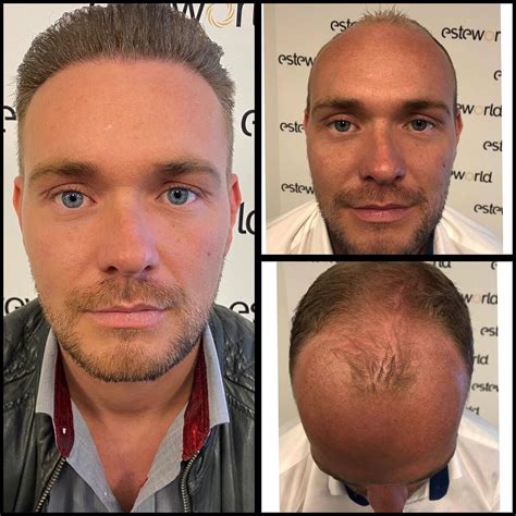 Haartransplantatie In Amsterdam: Top Opties En Prijzen