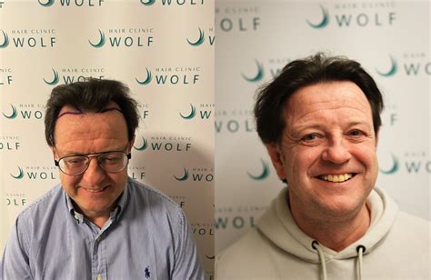 Haartransplantatie Met Saffier FUE: Wat Zijn De Verschillen?